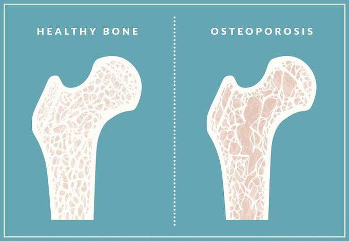 Treatment of osteoporosis