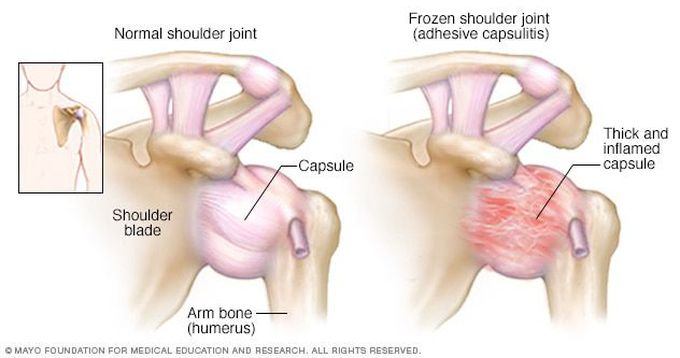 Adhesive Capsulitis