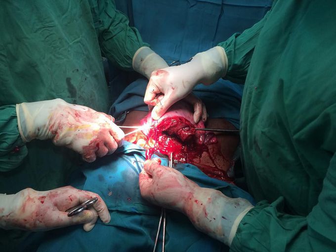 Another C-Section