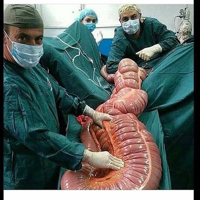 Toxic Mesocolon