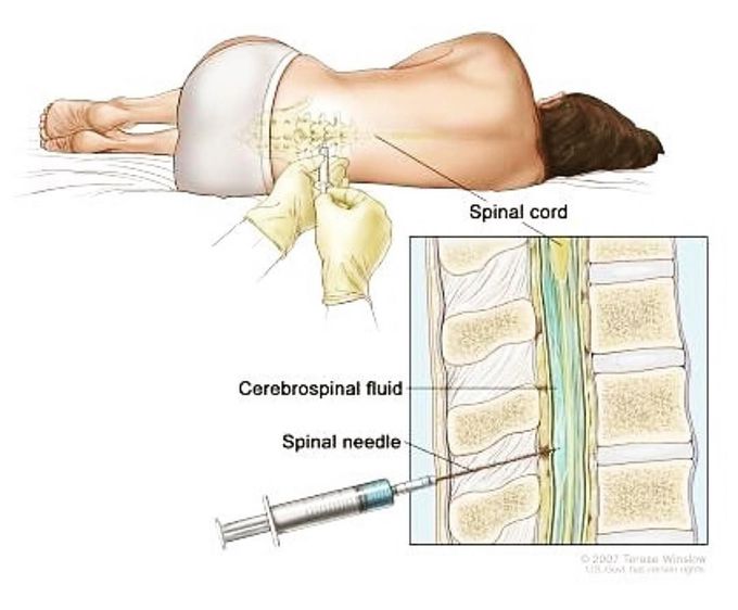 Lumbar Puncture