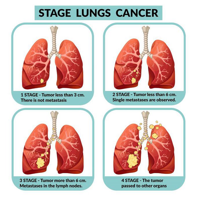 Lung cancer