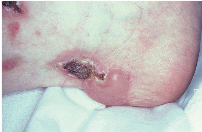 Bullous Pemphigoid.