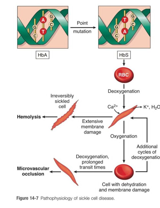 Sickle Cell Disease IV