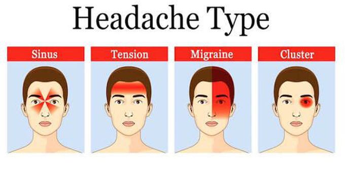 Types of headache - MEDizzy