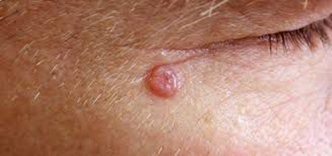 Symptoms of basal cell carcinoma