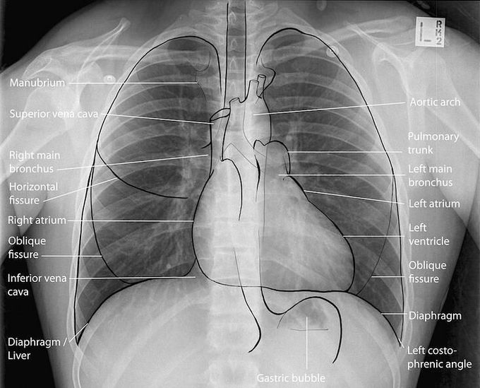 Chest X-Ray shows the mediastinal visible structures
