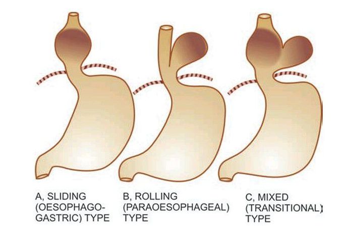 Hiatus hernia