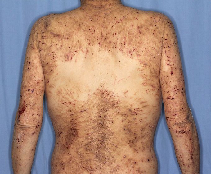 Chronic Generalized Pruritus