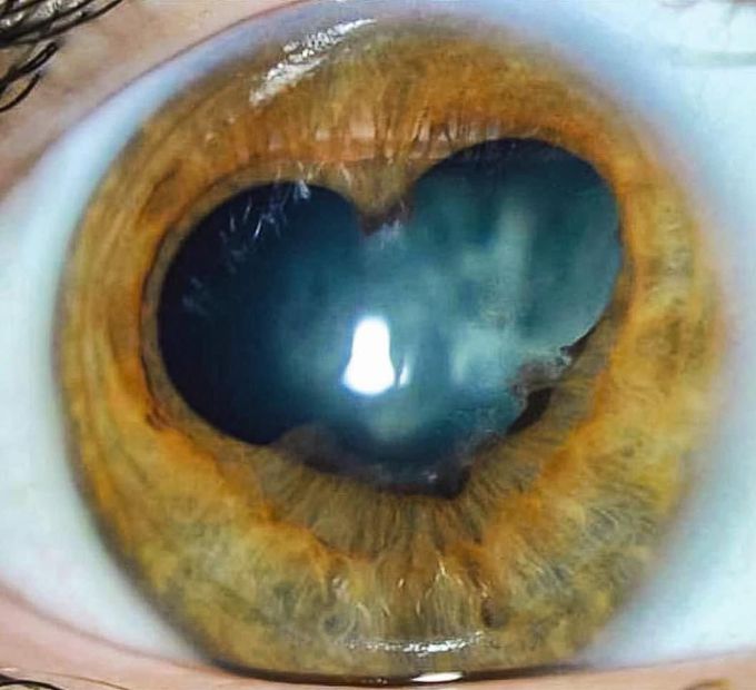 Heart shaped pupil