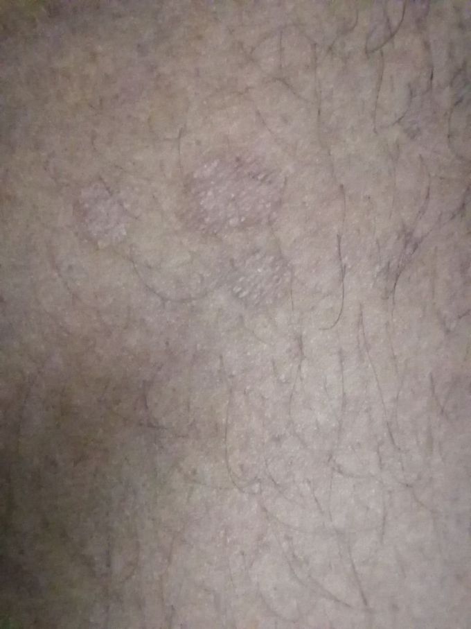 A young boy of 25 years old has this kind of scars on body. What are your opinion and treatment except fluconazole, cetrizine etc.