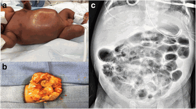 Risks of Necrotizing Enterocolitis