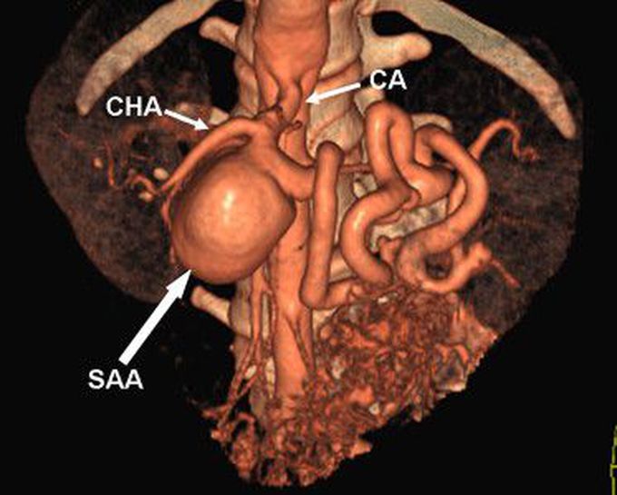 Splenic artery aneurysm