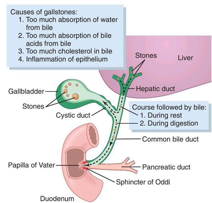 Gallstones