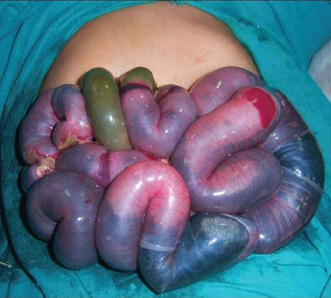 Gangrenous bowel.