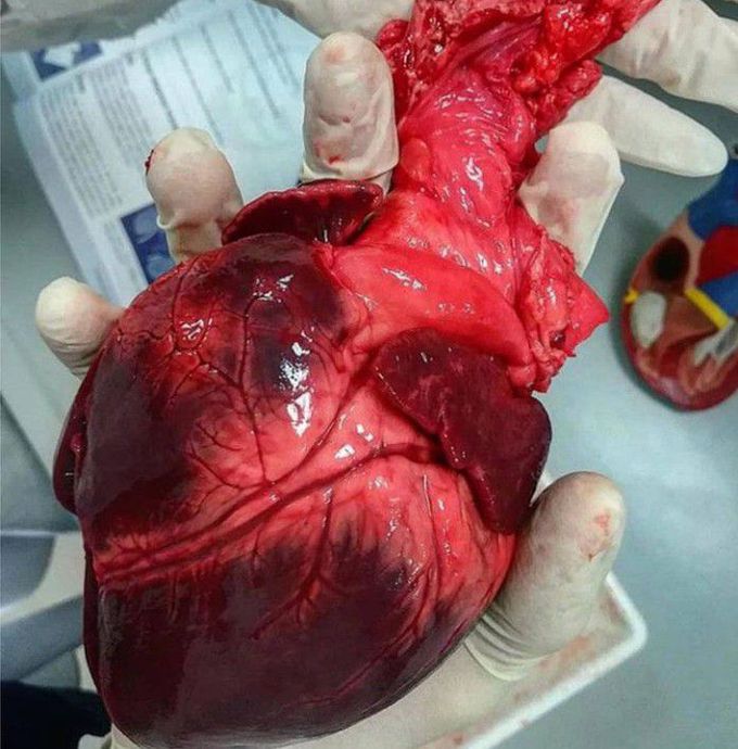 A fresh heart ready for implantation