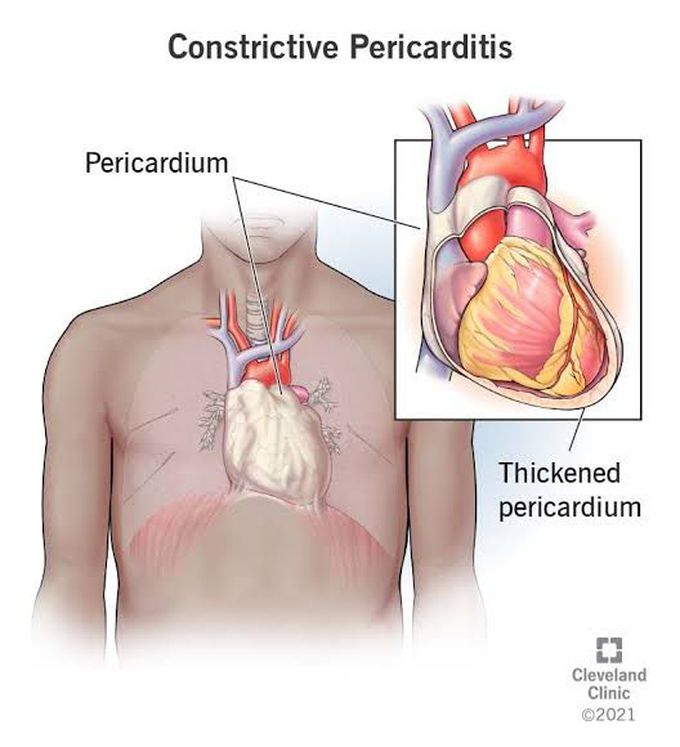 Constructive pericarditis