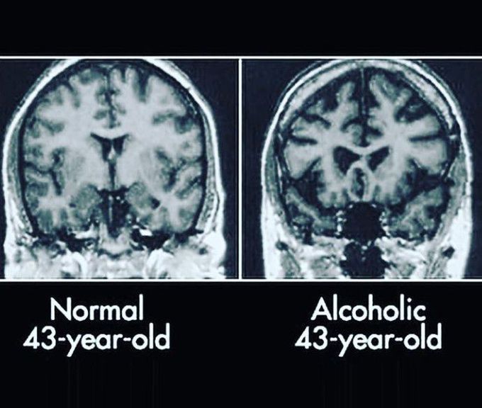 Normal Vs Alcoholic Brain