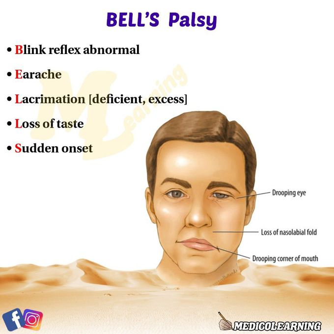Bell's palsy