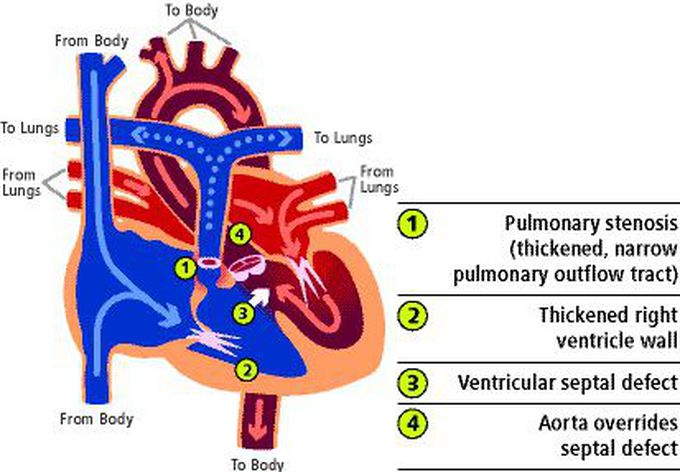 Teratology of fallot