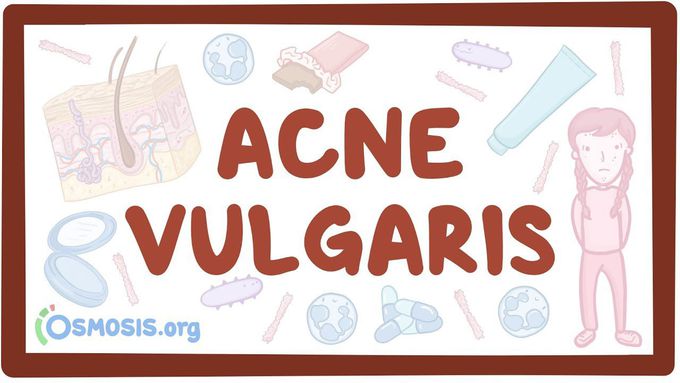 Acne vulgaris - causes, symptoms, diagnosis, treatment, pathology
