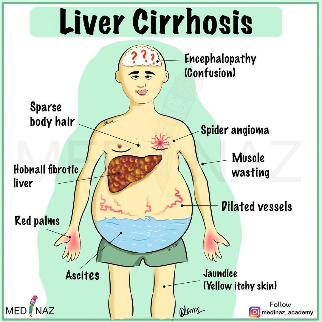 liver cirrhosis symptoms