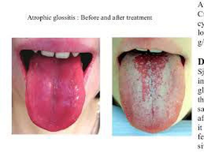 Symptoms of atrophic glossitis