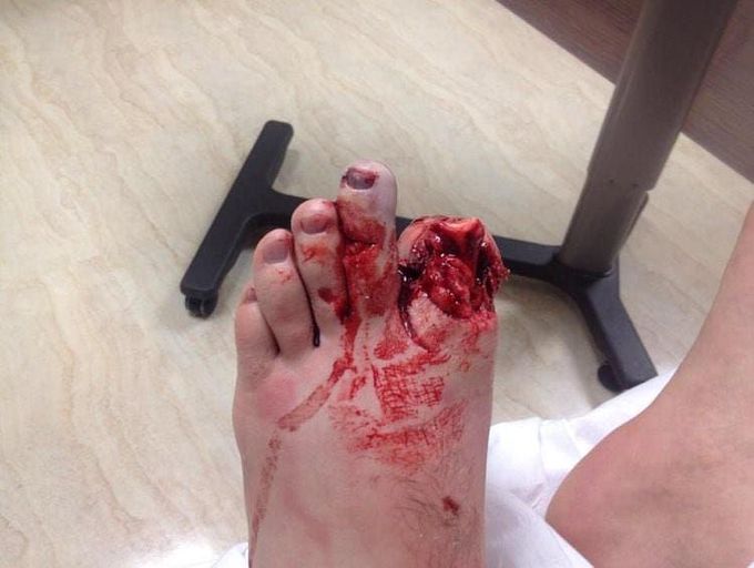 Motorcycle accident leaves rider with subamputated first and second toes.  