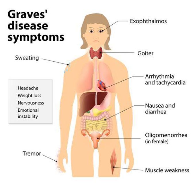 Graves Disease