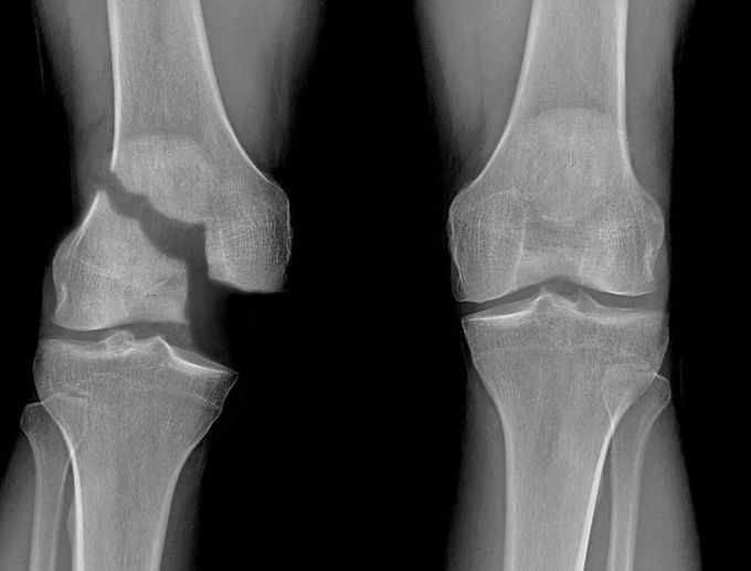 Salter Harris fracture