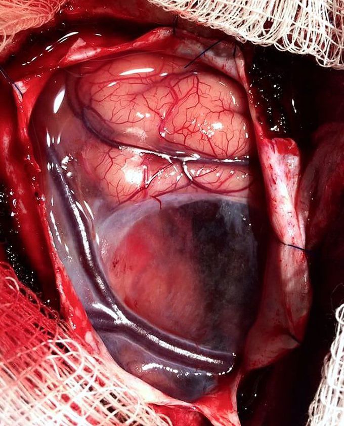 Left temporal arachnoid cyst