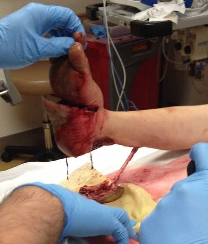 ⚠️ Lawn mower accident causing severe injurie to the patients foot. 