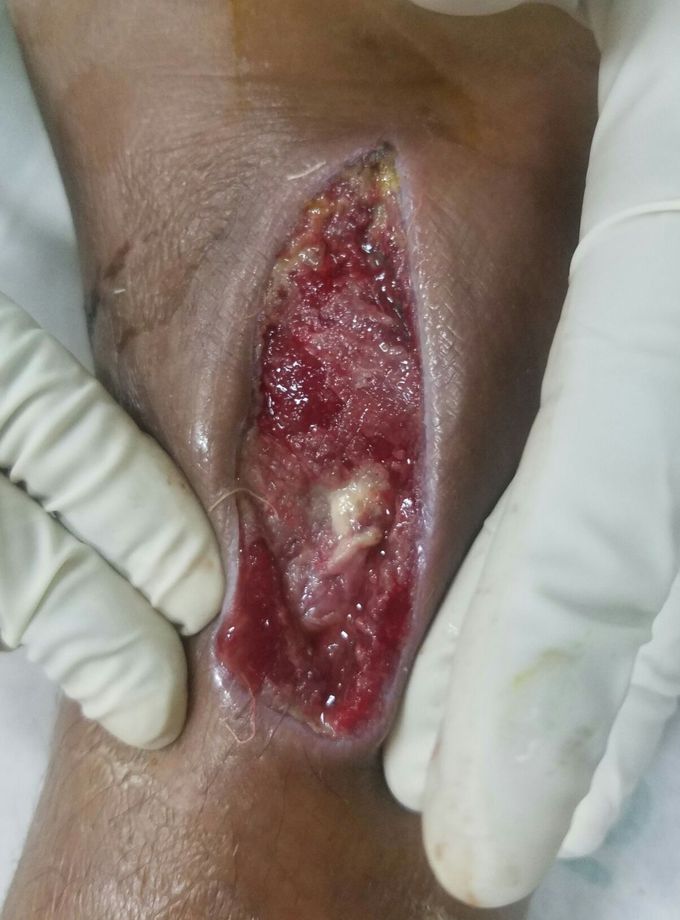 Bite from Animal
