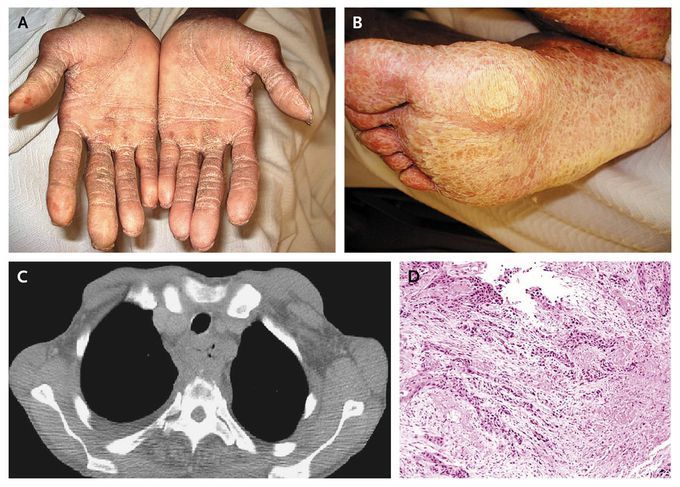 Palmoplantar Keratoderma Associated with Esophageal Cancer