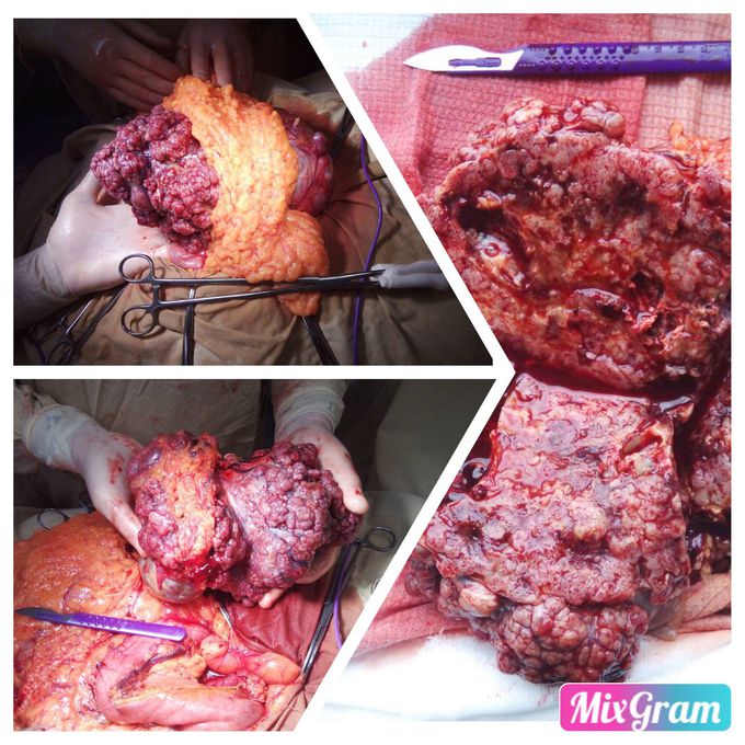 Big size GIST was removed with atypical resection of gaster (size more 20 sm!)