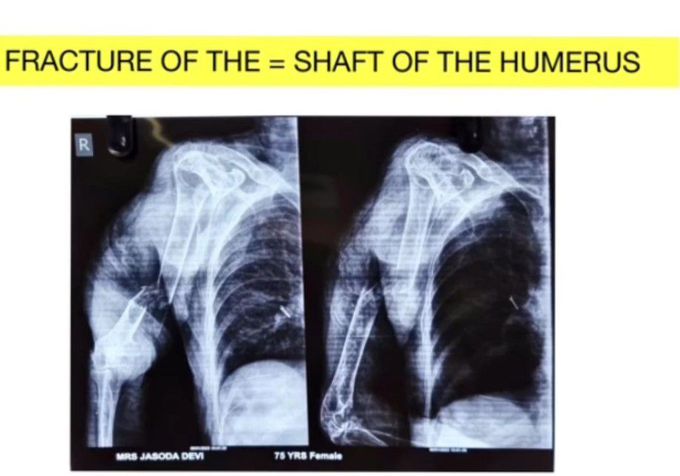 Fracture of the Humerus Shaft