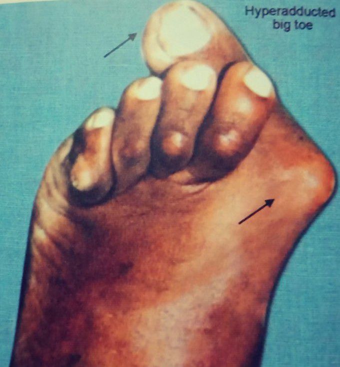 Hallux valgus - most common forefoot deformity