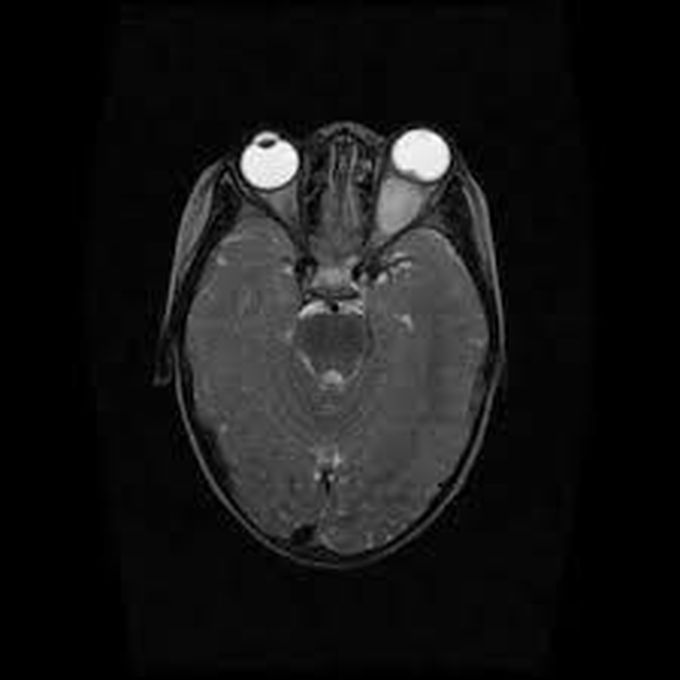 Symptoms of optic nerve glioma