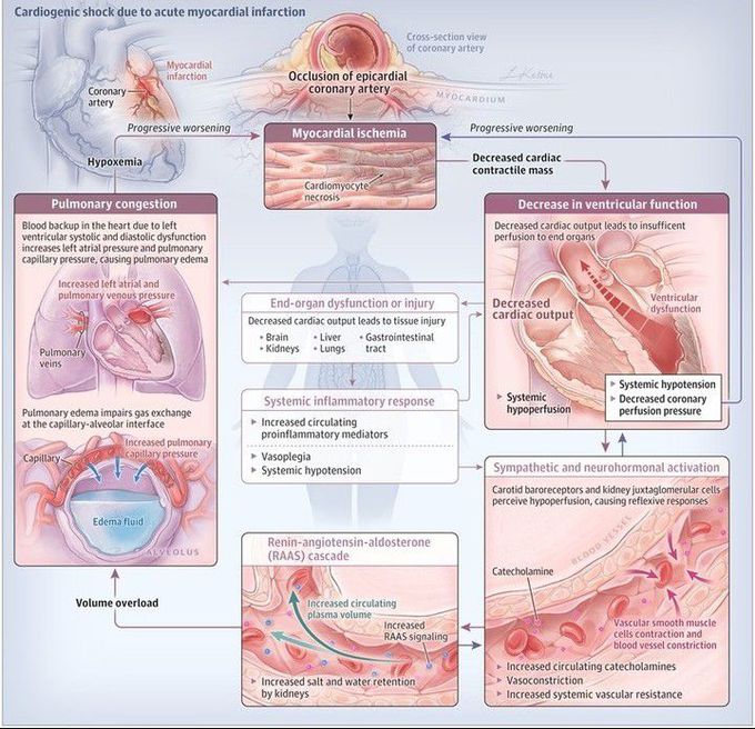 Cardiogenic shock