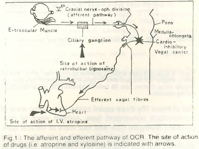 OCULOCARDIAC REFLEX