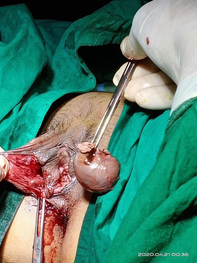 Bartholin cyst
