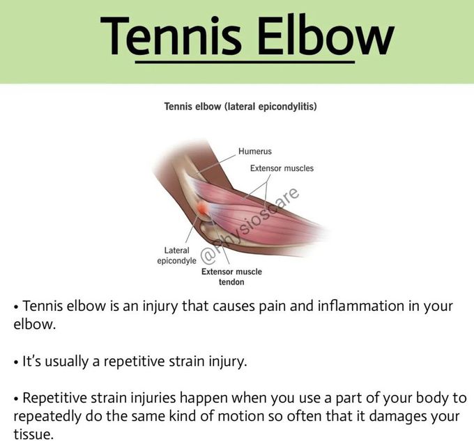 Tennis Elbow I