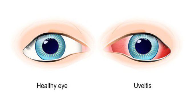 Uveitis