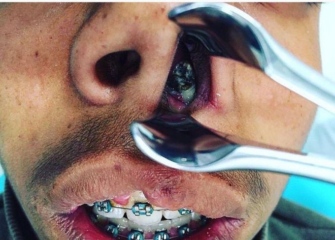 Decaying Tooth in Nose!