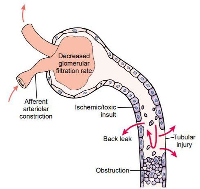 What causes acute tubular necrosis?