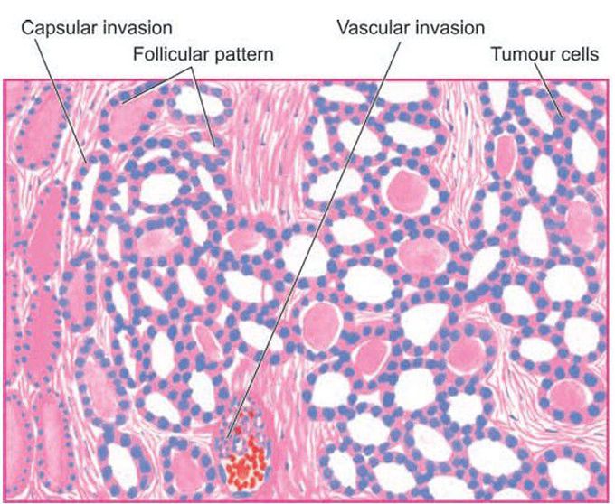 Follicular carcinoma