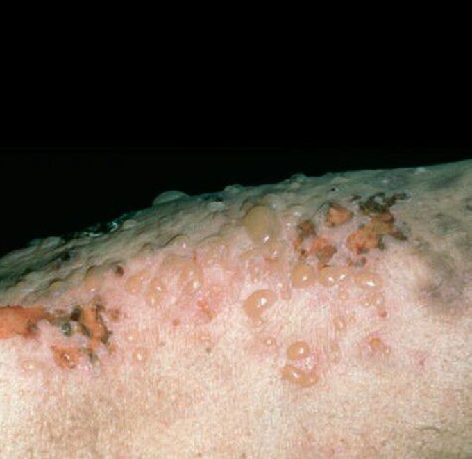 Bullous Pemphigoid