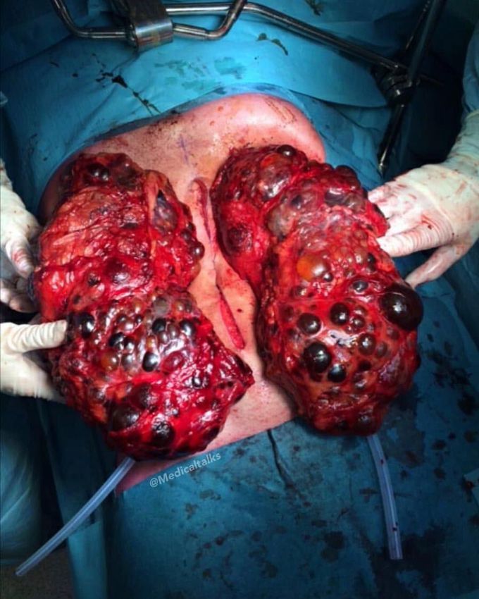 Polycystic kidneys - 30 pounds!! 