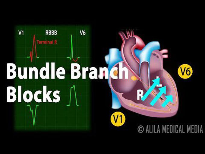 Heart blocks: Bundle branch blocks
