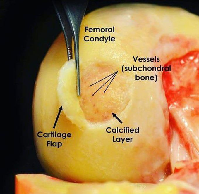 Focal chondral defect